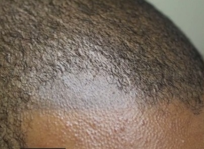 Hair loss hair loss